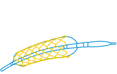 Design and development of an inflation device for angioplasty